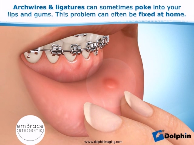 Poking Wires – Embrace Orthodontics